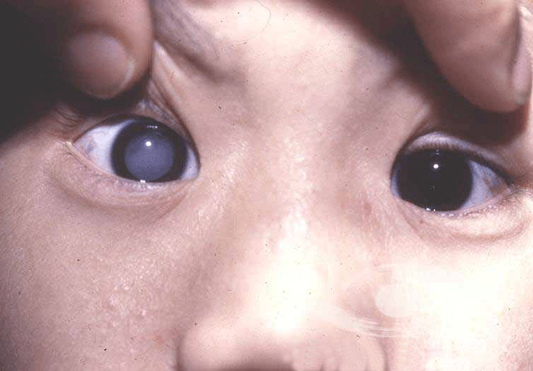 兒童白內(nèi)障