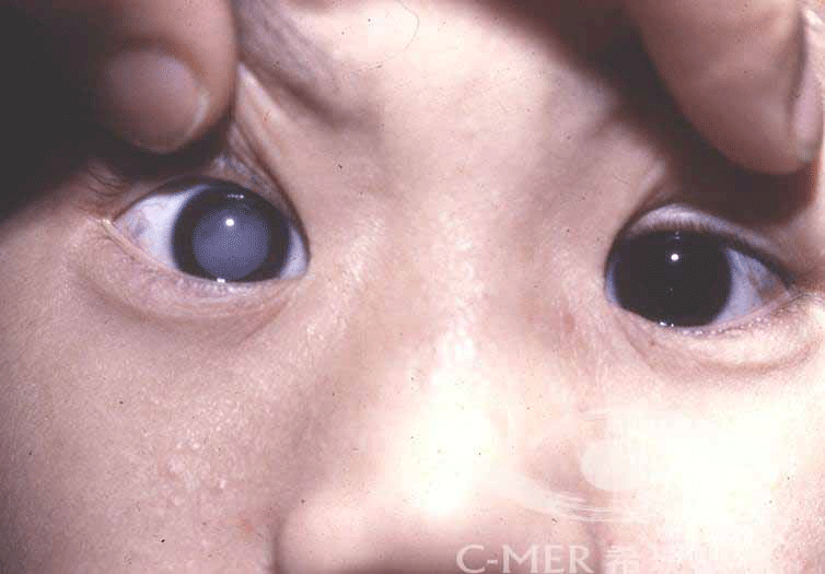 小兒白內(nèi)障