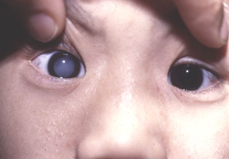 孩子有白內(nèi)障的癥狀有哪些